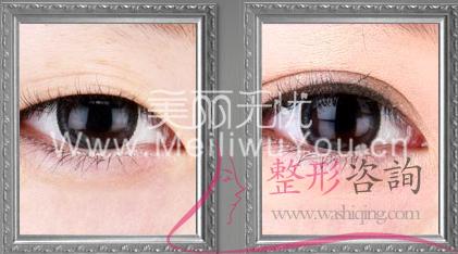 割<a href=http://www.bolangguoji.com/listinfo-724-0.html target=_blank class=infotextkey>雙眼皮</a>手術