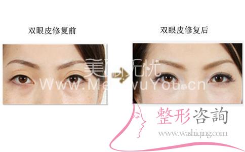 <a href=http://www.bolangguoji.com/listinfo-724-0.html target=_blank class=infotextkey>雙眼皮</a>修復(fù)