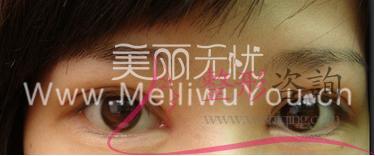 割開法<a href=http://www.bolangguoji.com/listinfo-724-0.html target=_blank class=infotextkey>雙眼皮</a>