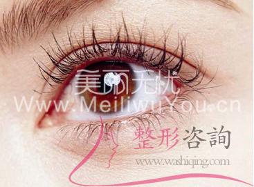 <a href=http://www.bolangguoji.com/listinfo-724-0.html target=_blank class=infotextkey>雙眼皮</a>手術