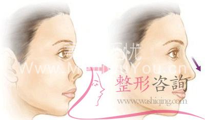 <a href=http://www.bolangguoji.com/listinfo-758-0.html target=_blank class=infotextkey>朝天鼻矯正</a>術