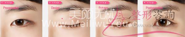 韓式三點<a href=http://www.bolangguoji.com/listinfo-724-0.html target=_blank class=infotextkey>雙眼皮</a>過程詳細說明圖