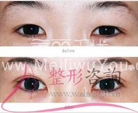 消融手術(shù)<a href=http://www.bolangguoji.com/listinfo-724-0.html target=_blank class=infotextkey>雙眼皮</a>