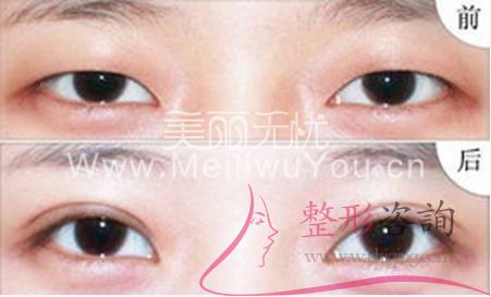 <a href=http://www.bolangguoji.com/listinfo-724-0.html target=_blank class=infotextkey>雙眼皮</a>