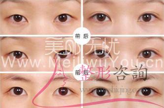 割<a href=http://www.bolangguoji.com/listinfo-724-0.html target=_blank class=infotextkey>雙眼皮</a>