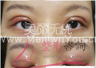 <a href=http://www.bolangguoji.com/listinfo-724-0.html target=_blank class=infotextkey>雙眼皮</a>手術(shù)：開<a href=http://www.bolangguoji.com/listinfo-724-0.html target=_blank class=infotextkey>雙眼皮</a>最好樣子