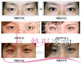 韓式<a href=http://www.bolangguoji.com/listinfo-724-0.html target=_blank class=infotextkey>雙眼皮</a>獨具一格優(yōu)勢 專家超超超強力強烈推薦