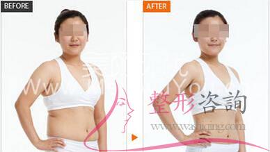 腹部<a href=http://www.bolangguoji.com/listinfo-685-0.html target=_blank class=infotextkey>吸脂</a>術