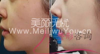 打<a href=http://www.bolangguoji.com/listinfo-790-0.html target=_blank class=infotextkey>水光針</a>