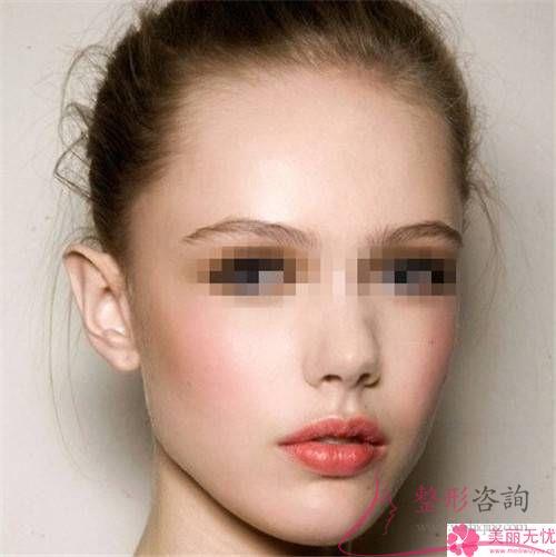 582元激光能醫治臉部紅血絲嗎？是否傷害膚質？