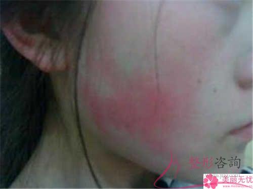 582元激光能醫治臉部紅血絲嗎？是否傷害膚質？