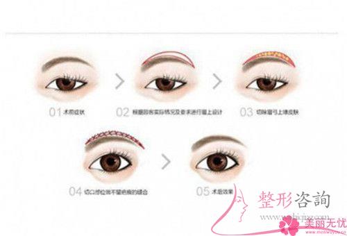 一次皮秒激光<a href=http://www.bolangguoji.com/listinfo-658-0.html target=_blank class=infotextkey>洗眉</a>能夠清潔凈紋眉嗎