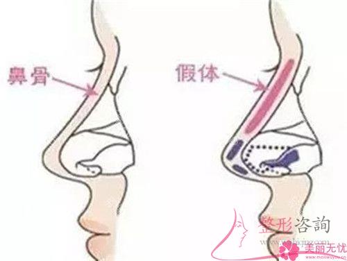 假體硅膠<a href=http://www.bolangguoji.com/listinfo-737-0.html target=_blank class=infotextkey>隆鼻</a>成效能維持好久？得住院嗎？