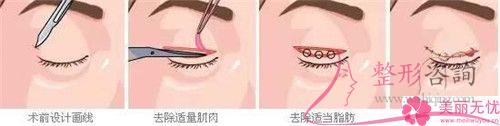 <a href=http://www.bolangguoji.com/listinfo-711-0.html target=_blank class=infotextkey>開眼角</a>得到的效果能夠持續25年嗎