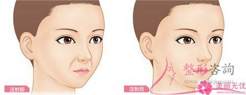 怎么樣徹底去除法令紋？指壓方法能<a href=http://www.bolangguoji.com/listinfo-780-0.html target=_blank class=infotextkey>去魚尾紋</a>嗎？