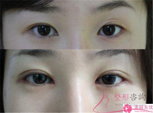 激光<a href=http://www.bolangguoji.com/listinfo-658-0.html target=_blank class=infotextkey>洗眉</a>毛術前術后對比效果怎樣？3307元能做嗎