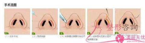 <a href=http://www.bolangguoji.com/listinfo-754-0.html target=_blank class=infotextkey>鼻翼</a>整形后萬一再次外擴怎么辦