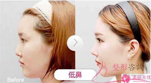 <a href=http://www.bolangguoji.com/listinfo-738-0.html target=_blank class=infotextkey>鼻綜合</a>怎樣恢復(fù)的快