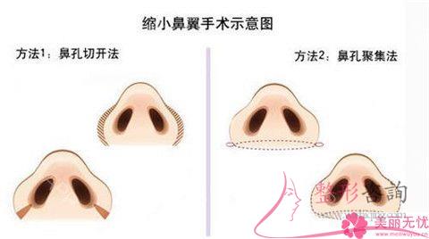 不美觀的<a href=http://www.bolangguoji.com/listinfo-754-0.html target=_blank class=infotextkey>鼻翼</a>應該怎么辦