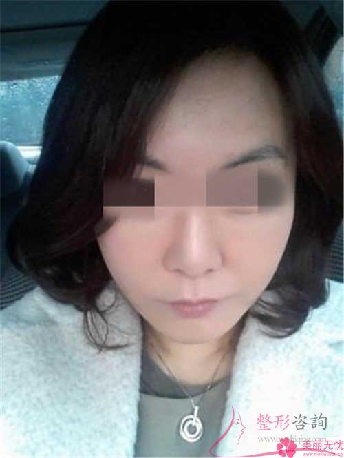 具體哪種填充<a href=http://www.bolangguoji.com/listinfo-614-0.html target=_blank class=infotextkey>除皺</a>措施適用于32歲的小伙伴們