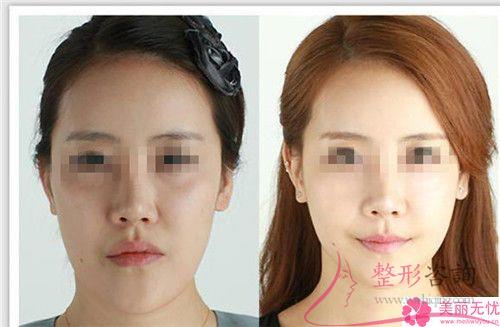 削骨<a href=http://www.bolangguoji.com/listinfo-631-0.html target=_blank class=infotextkey>瘦臉</a>術得注意什么