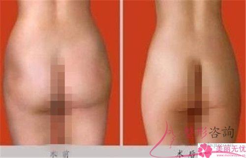 哪些人群能夠接受自體<a href=http://www.bolangguoji.com/listinfo-677-0.html target=_blank class=infotextkey>豐臀</a>