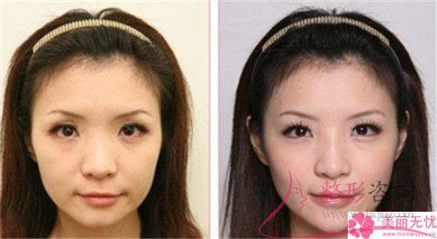 實施復合彩光<a href=http://www.bolangguoji.com/listinfo-770-0.html target=_blank class=infotextkey>嫩膚</a>終止會怎么樣？會復發嗎？