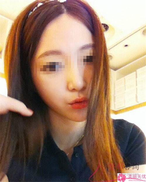 磨骨<a href=http://www.bolangguoji.com/listinfo-631-0.html target=_blank class=infotextkey>瘦臉</a>改臉型幾乎要好長時間還原，該怎么調理