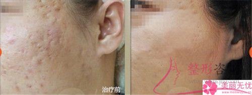 紅光與藍光祛痘存在一些什么優(yōu)點