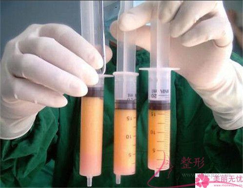 線雕提升術(shù)去除鼻唇溝皺紋貴嗎？多少元