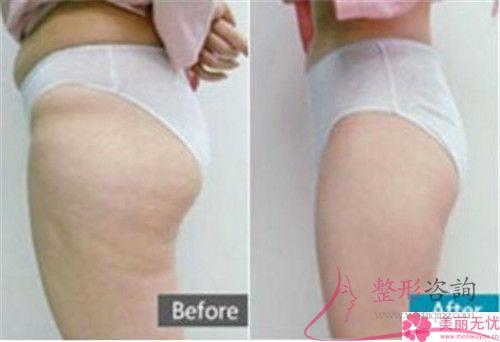 自體組織<a href=http://www.bolangguoji.com/listinfo-677-0.html target=_blank class=infotextkey>豐臀</a>的四個優點