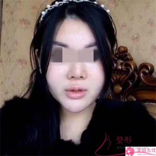 鋸齒線懸掛緊致去皺術(shù)到底有哪些具體的功能