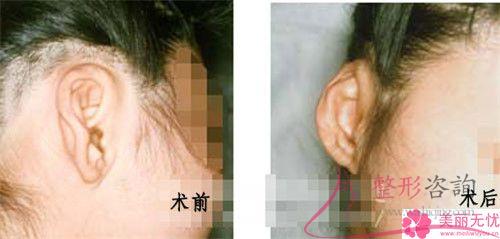 傷口沾水后不利于自體脂肪<a href=http://www.bolangguoji.com/listinfo-694-0.html target=_blank class=infotextkey>豐耳垂</a>后的恢復嗎