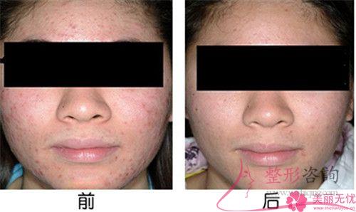 激光去痘痕大概的費用是多少