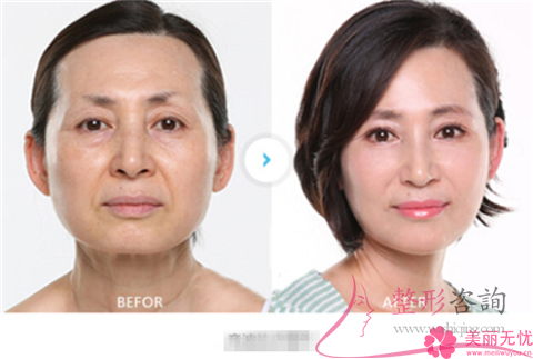 <a href=http://www.bolangguoji.com/listinfo-611-0.html target=_blank class=infotextkey>超聲刀</a>提升痛不痛啊