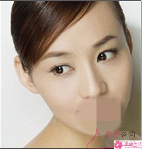 眉弓去薄會不會過于凹陷