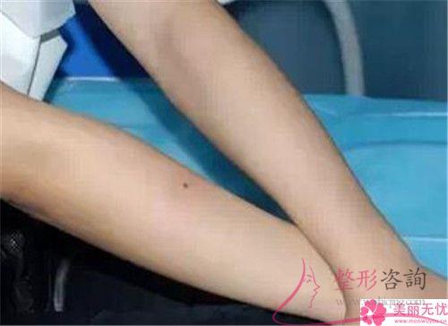 去除唇毛運用冰點<a href=http://www.bolangguoji.com/listinfo-670-0.html target=_blank class=infotextkey>脫毛</a>有危險嗎