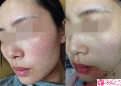 彩光去除黃褐斑和<a href=http://www.bolangguoji.com/listinfo-790-0.html target=_blank class=infotextkey>水光針</a>一同實施多少錢