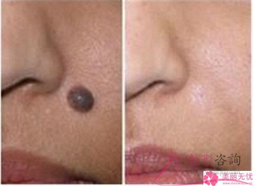 彩光去除黃褐斑和<a href=http://www.bolangguoji.com/listinfo-790-0.html target=_blank class=infotextkey>水光針</a>一同實施多少錢