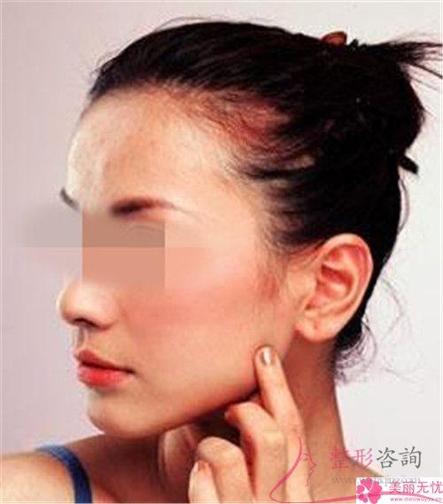 拴馬樁耳整形術流程究竟是怎么樣的