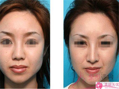 注入奧美定<a href=http://www.bolangguoji.com/listinfo-737-0.html target=_blank class=infotextkey>隆鼻</a>的常見注意事項(xiàng)有哪些