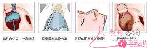 注射微晶瓷<a href=http://www.bolangguoji.com/listinfo-737-0.html target=_blank class=infotextkey>隆鼻</a>的常見(jiàn)注意事項(xiàng)具體有哪些