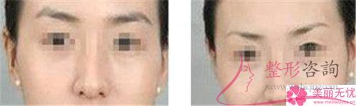 <a href=http://www.bolangguoji.com/listinfo-658-0.html target=_blank class=infotextkey>洗眉</a>毛用激光能清潔凈嗎？費用是呢