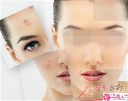 激光<a href=http://www.bolangguoji.com/listinfo-795-0.html target=_blank class=infotextkey>祛斑</a>反黑現象怎么做