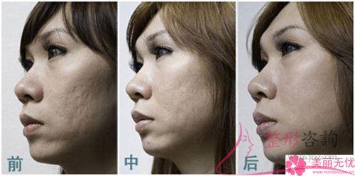美萊激光祛痘該怎樣打理？結(jié)果如何？
