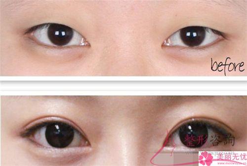 韓式<a href=http://www.bolangguoji.com/listinfo-724-0.html target=_blank class=infotextkey>雙眼皮</a>法是埋線<a href=http://www.bolangguoji.com/listinfo-724-0.html target=_blank class=infotextkey>雙眼皮</a>法嗎？是可以保持多長時間