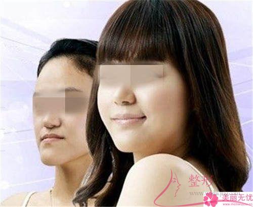 <a href=http://www.bolangguoji.com/listinfo-629-0.html target=_blank class=infotextkey>下頜角</a>整形手術(shù)哪一個(gè)手術(shù)方法<a href=http://www.bolangguoji.com/listinfo-631-0.html target=_blank class=infotextkey>瘦臉</a>效果好