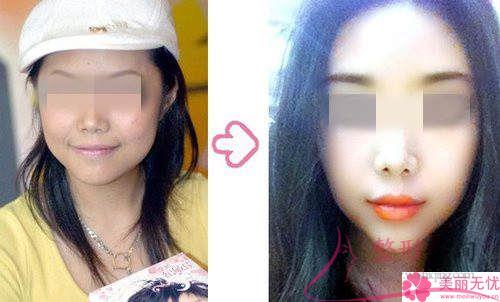 下<a href=http://www.bolangguoji.com/listinfo-644-0.html target=_blank class=infotextkey>頜骨整形</a>術能不能讓我成為瓜子臉