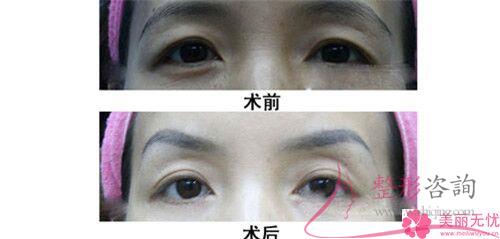激光<a href=http://www.bolangguoji.com/listinfo-658-0.html target=_blank class=infotextkey>洗眉</a>毛改善效果與費用各自是什么