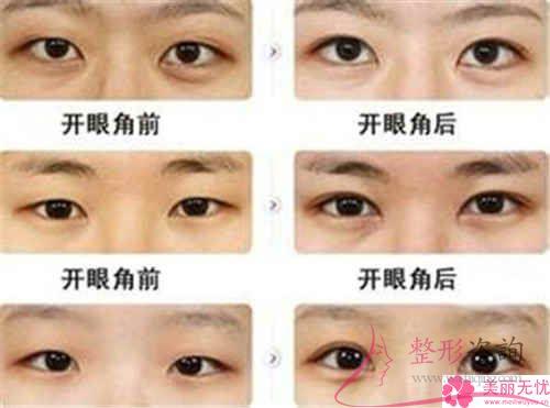 不同的6大<a href=http://www.bolangguoji.com/listinfo-711-0.html target=_blank class=infotextkey>開眼角</a>手術(shù)的優(yōu)點(diǎn)